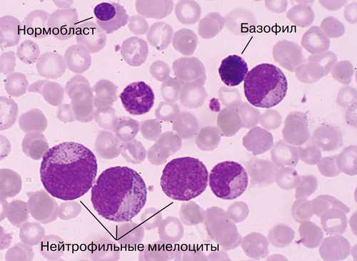 Все о раке крови лейкемия, лейкоз у взрослых и детей и его лечении