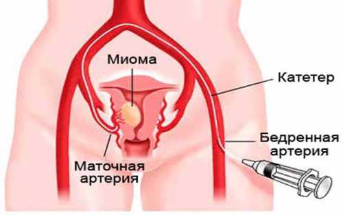 Лечение узловой миомы матки