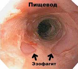 Причины воспаления слизистой пищевода