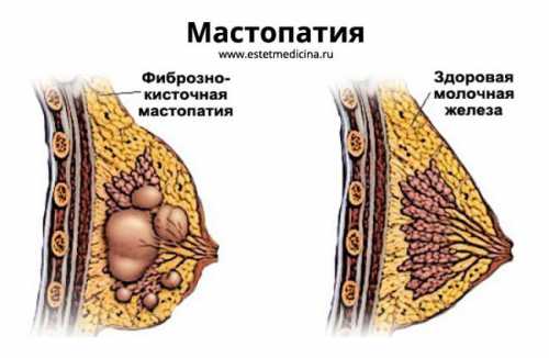 Мастопатия Что это такое Как же проявляется мастопатия