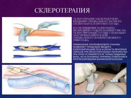 Довольно часто клиническая картина напоминает обычную простуду или грипп именно поэтому женщины попросту игнорируют проблему и отказываются обращаться к врачу