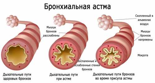 Боль в груди