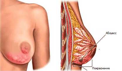 Лактостаз: описание, причины, симптомы,  лечение